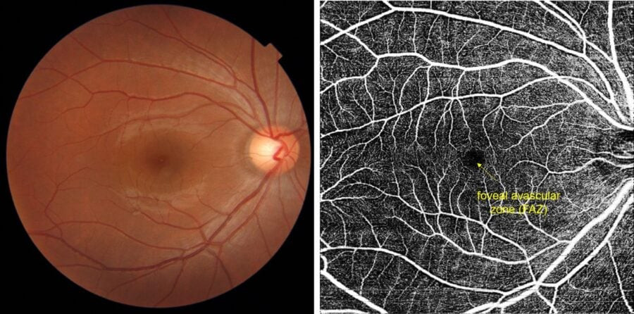 Thanks to AI, it will be possible to predict the risk of cardiovascular diseases by scanning the retina of the eye