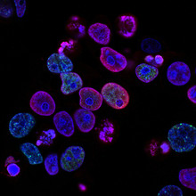 Light therapy was first used successfully to treat cancer